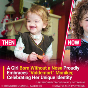 Girl Born Without a Nose Proudly Embraces “Voldemort” Moniker, Celebrating Her Unique Identity