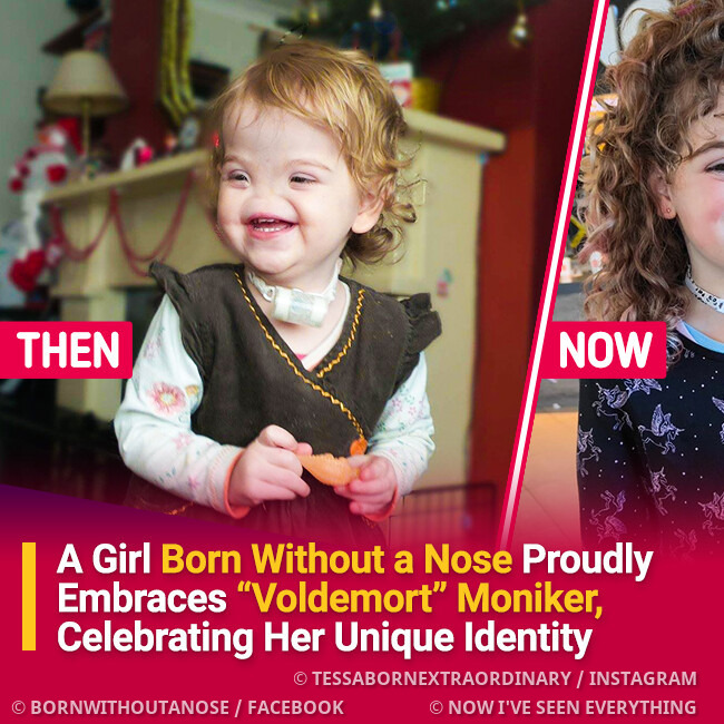Girl Born Without a Nose Proudly Embraces “Voldemort” Moniker, Celebrating Her Unique Identity