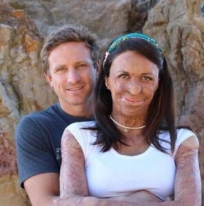 After a Fire Scarred His Wife, Her Husband’s Love Remained Unshaken