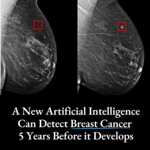 A new type of Artificial Intelligence can detect breast cancer 5 years before diagnosis