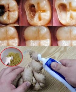 How to naturally repair a cavity. Keep these tips in mind to avoid visiting the dentist Full recipe in the first comment