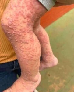 Her Whole Body Was Itchy: What She Thought Was a Common Allergy Was Hiding Something More Serious