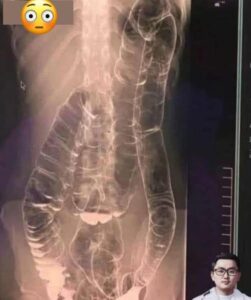 This is an X-ray image of a young woman who suffered from chronic constipation. One day, after experiencing continuous symptoms for over two weeks, she went for a medical check-up and received the X-ray results shown below in comments…