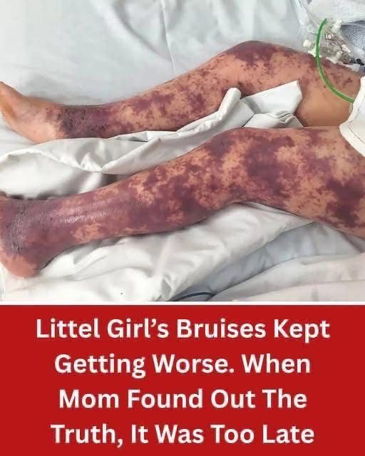 Little Girl’s Bruises Kept Getting Worse. When Mom Found Out The Truth, It Was Too Late