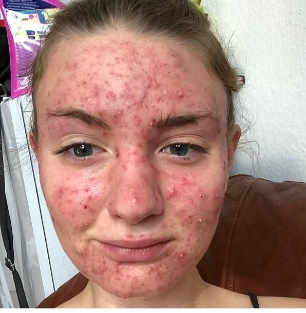 Her body was itching, I thought it was an allergy, they diagnosed ca… see more