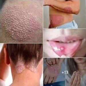 Signs of Human Papillomavirus You Should Know