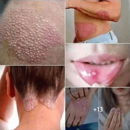 Signs of Human Papillomavirus You Should Know