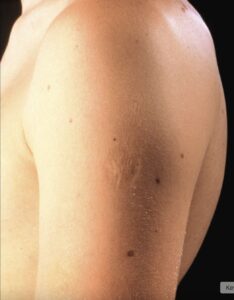 Here’s The Truth Behind This Scar On People’s Upper Left Arm