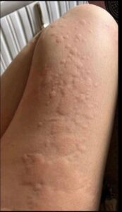 His body was itchy, he thought it was an allergy