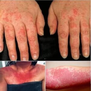 HT9. Red, Itchy, and Sweaty Skin are the consequences of having s… See more