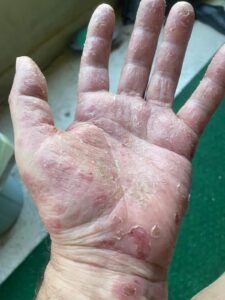 Unusual Case of Sweet Syndrome Triggered by New Inhaler Therapy in Primary Care
