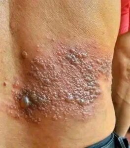 It was itching his body, he thought it was an allergy, but a tough diagnosis… See more