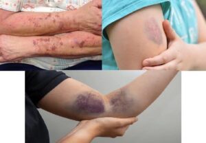 BE CAREFUL, if you get these bruises on your body, it means you have…