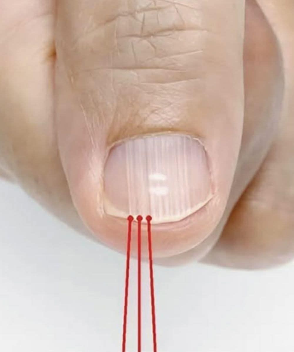 If you have these lines on your nails after