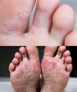 War:ning: If you have this on your feet, it may be a sign of hidden diabetes, stay al:ert