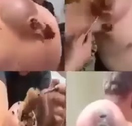 Doctors Couldn’t Believe What Was Inside This Swelling… See for Yourself!