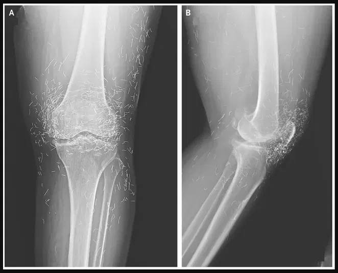X-Ray Reveals Hundreds of Gold Needles in Woman’s Knees