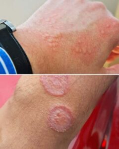 When an Itch Isn’t Just an Itch: James’s Story and the Silent Warning Signs of Skin Conditions