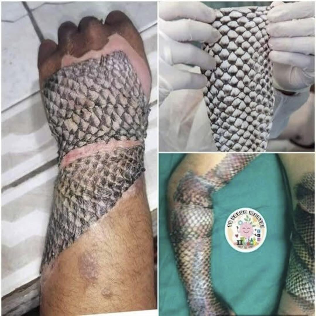Tilapia skin has changed the lives of thousands of people who have suffered burns…see more