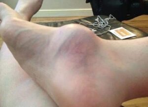 The Lump on Her Foot: A Difficult Journey of Ignorance and Strength