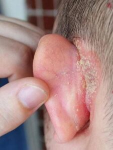 I noticed a strange patch of skin on my son’s ear