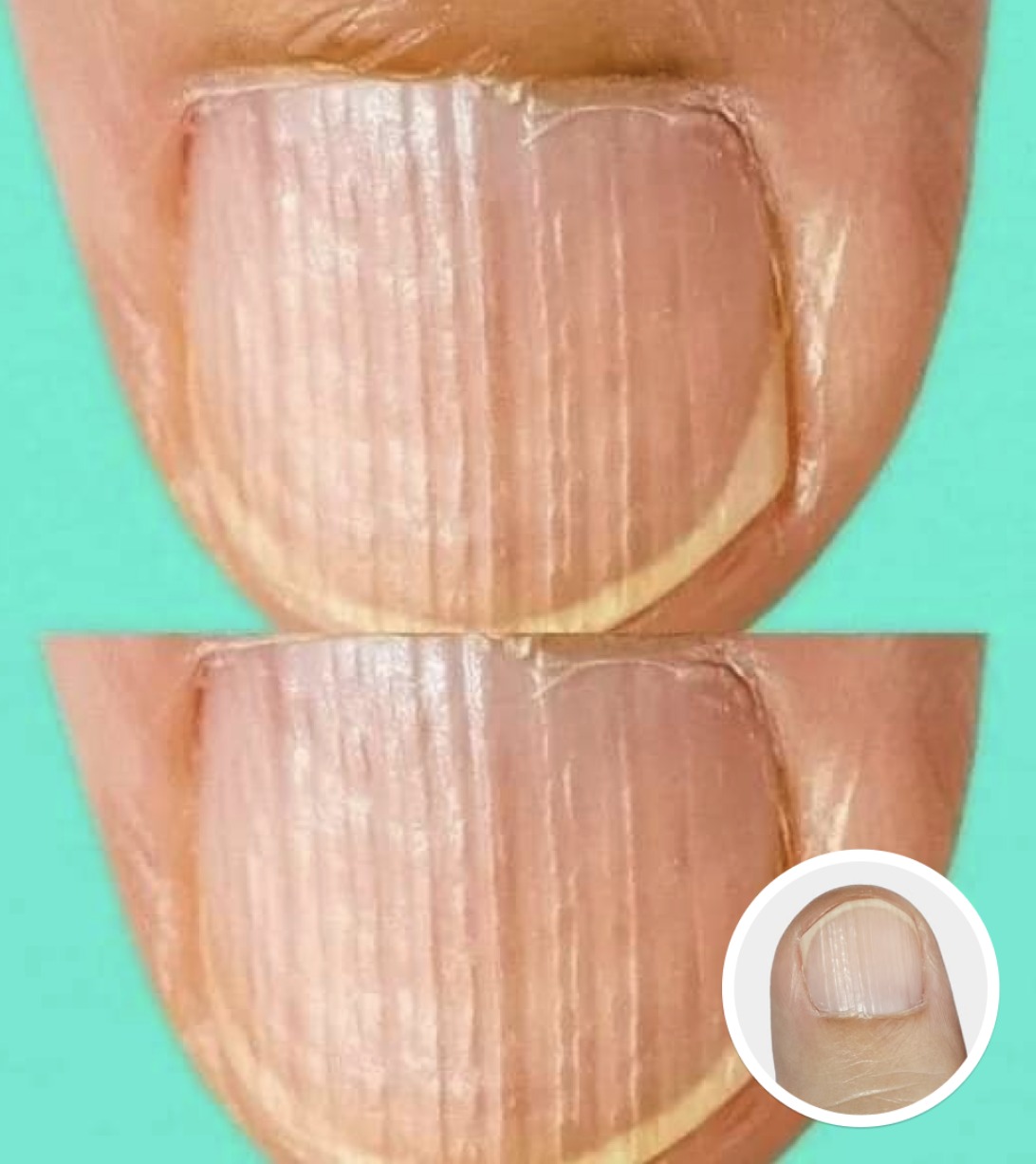 Doctor Explains What It Means If You Have Ridges On Your Fingernails