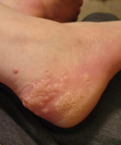 My 9-year-old son been wearing the kid that stays down the street from our house shoes and now he’s dealing with yellow bumps.. What is it 😫