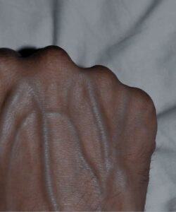Why Veins May Look More Visible Sometimes